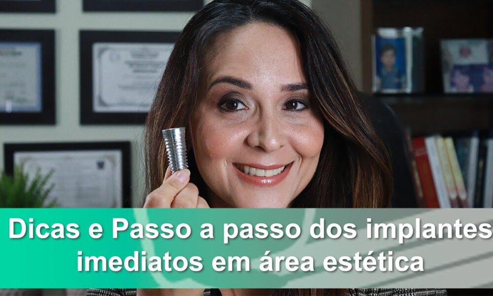 Dicas e Passo a passo dos implantes imediatos em área estética Você pode Mudar